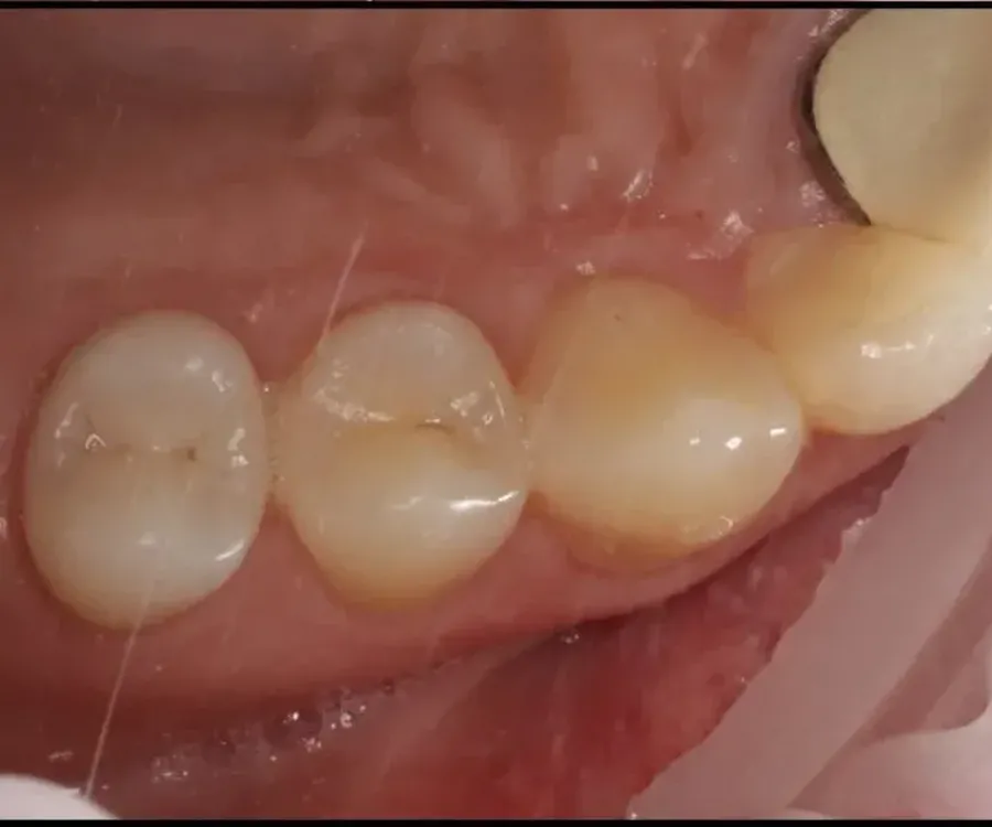 Caries treatment 2 after