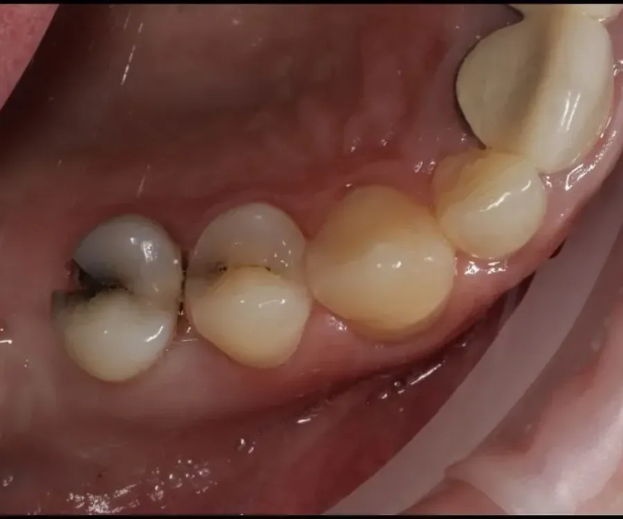 Caries treatment 2 before