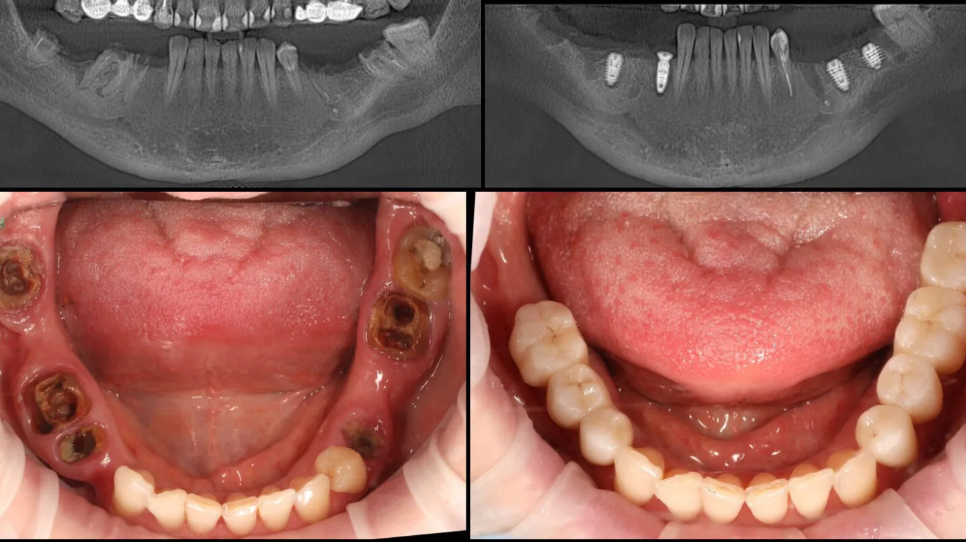 Collage імплантація